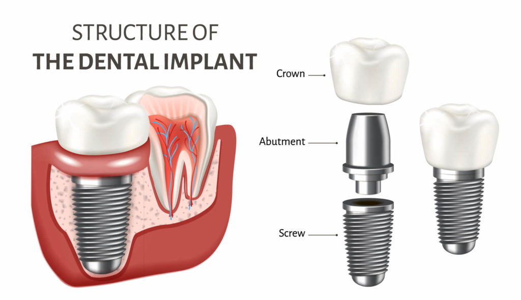 Dental Implants Prince Albert