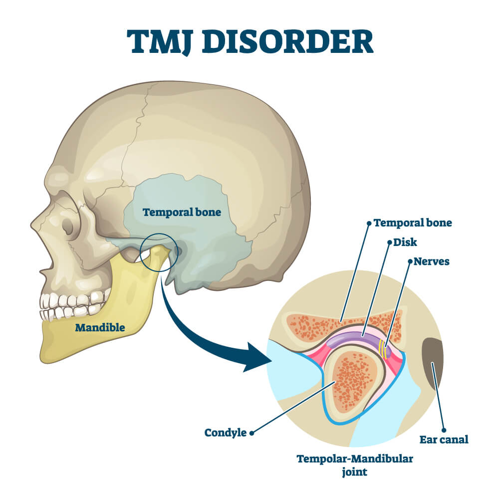 TMJ Disorder Prince Albert